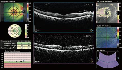 my oct test for thickness was 0.78|retinal thickness measurement oct.